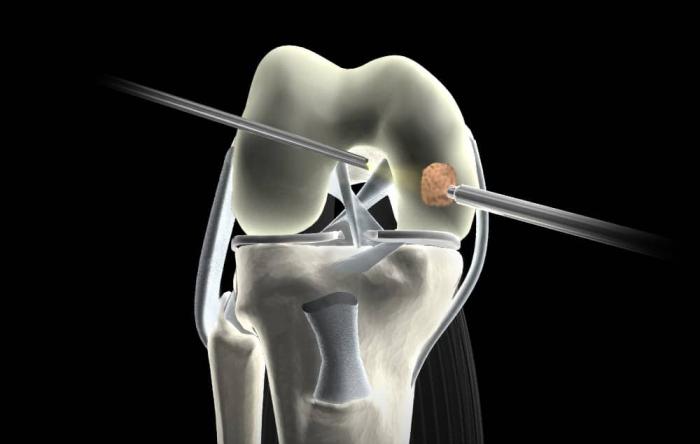 arthroscopic-surgery-arthroscopy-surgery-in-krishna-nagar-east-delhi